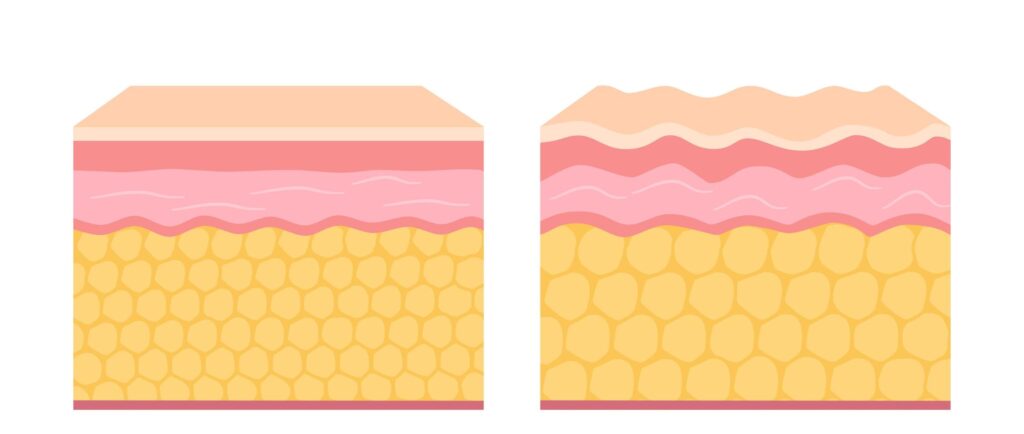 cellulite