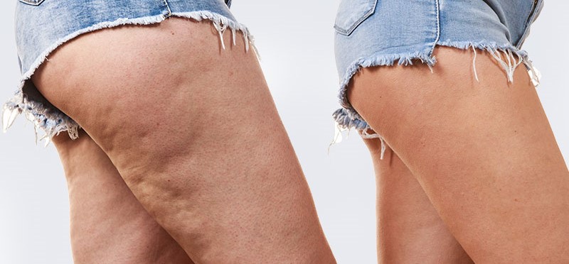 how to reduce cellulite at home