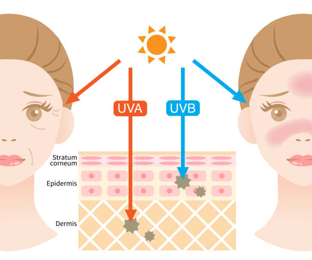skin layer illustrationn of UVA rays penetrate deep into the dermis causing winkle. UVB rays damage the epidermis to produce sunburn