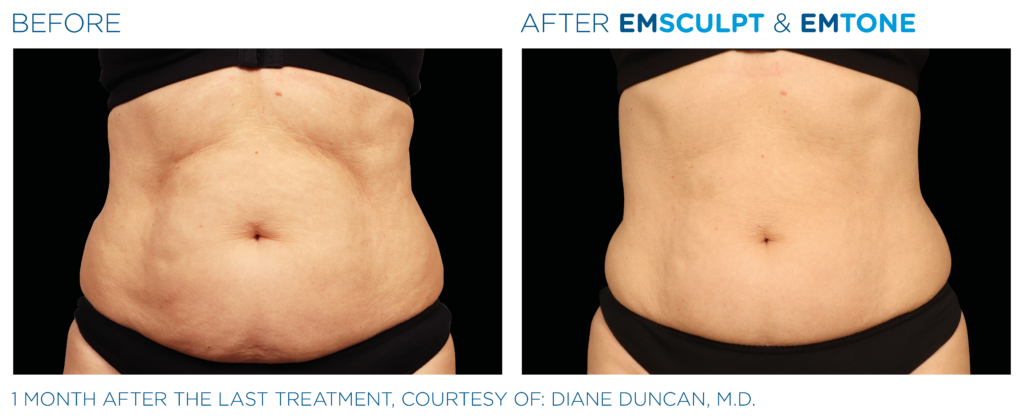 EmTone & Emsculpt Neo before and after abdomen toning results, Cryo Studio Sarasota