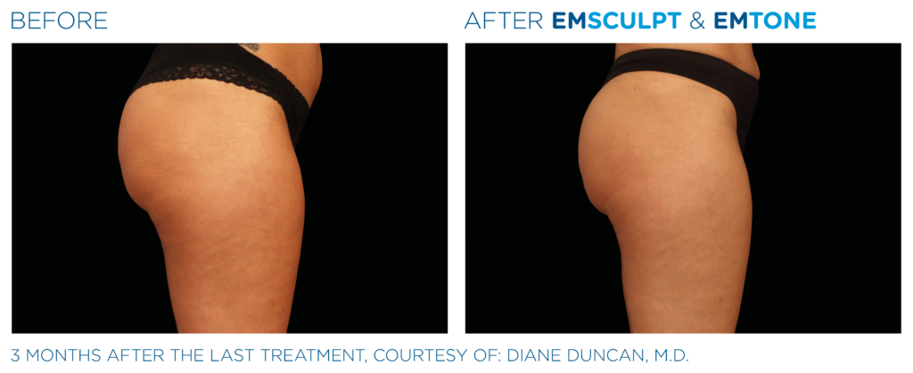 Non-surgical butt lift before and after with Emsculpt Neo at Cryo Studio Sarasota