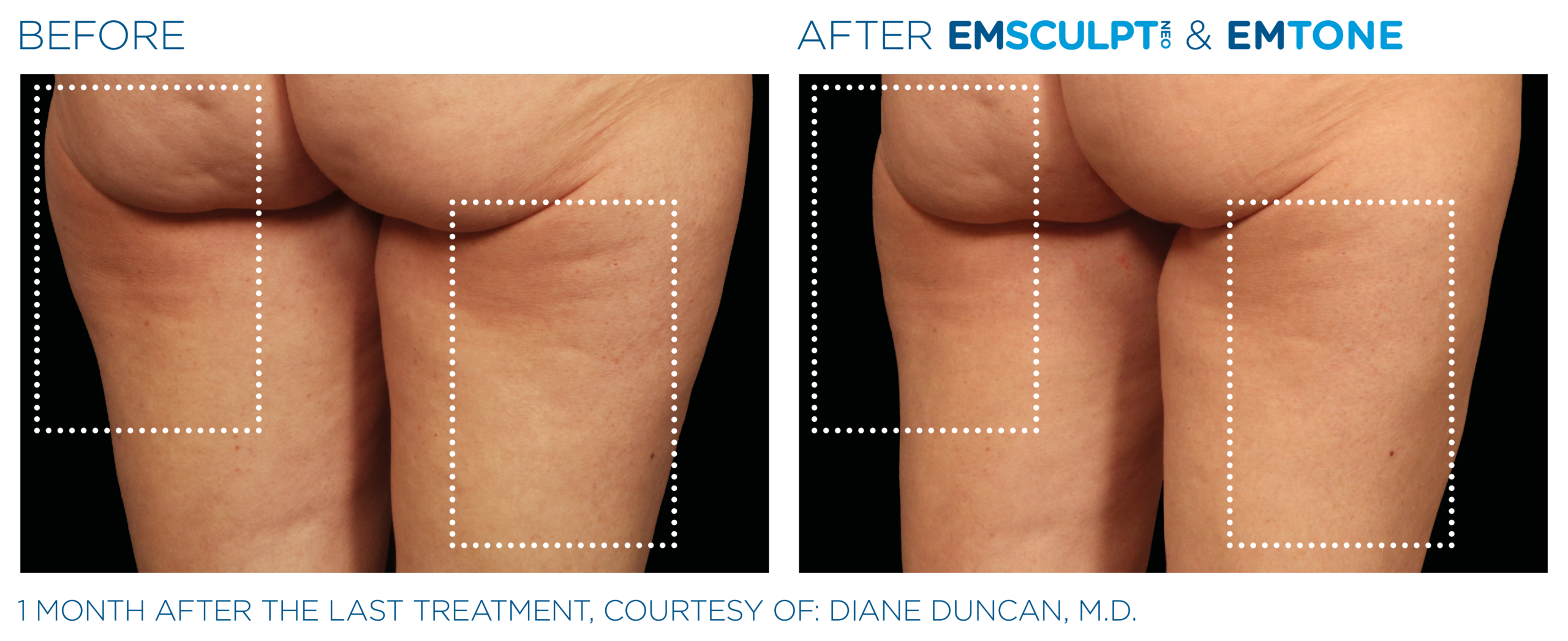 Emsculpt Neo and EmTone before-and-after on the back of the thighs at Cryo Studio Sarasota