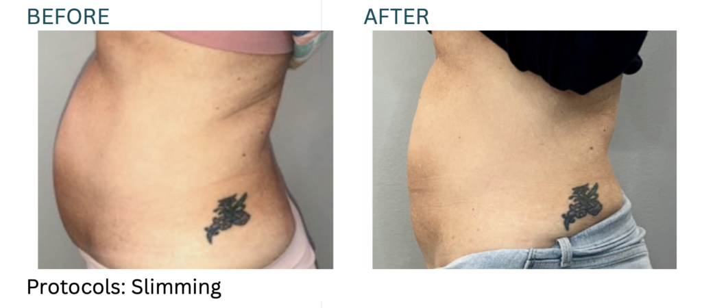 Cryo Slimming before and after results at Cryo Studio Sarasota