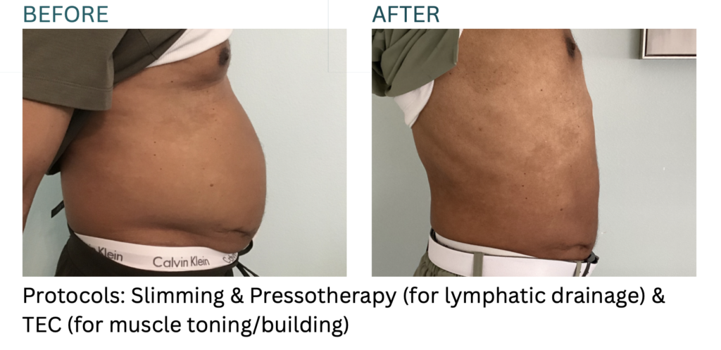 Cryo Slimming client results at Cryo Studio Sarasota