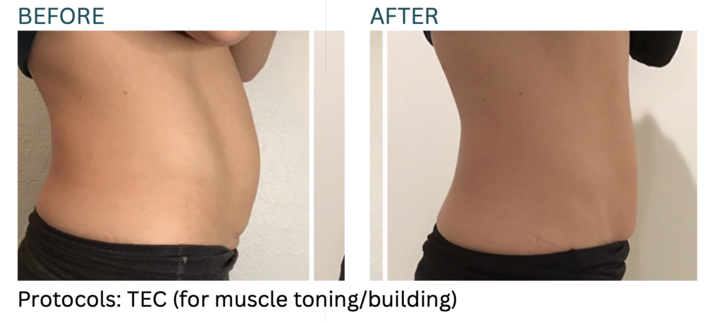 Emsculpt Neo before and after results at Cryo Studio Sarasota