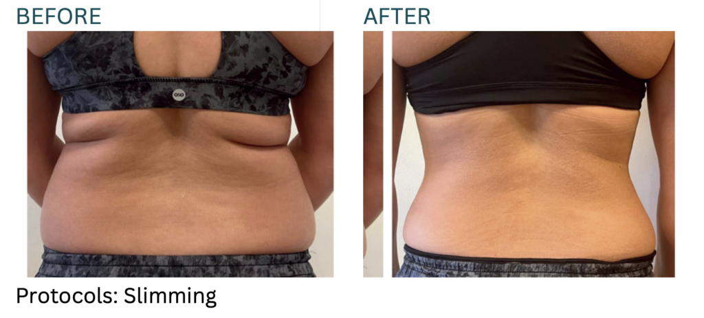 Cryo Slimming before and after results at Cryo Studio Sarasota