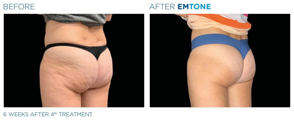 EmTone body skin tightening treatment at Cryo Studio Sarasota